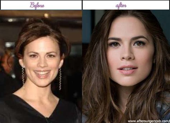 Hayley Atwell Plastic Surgery Before and After